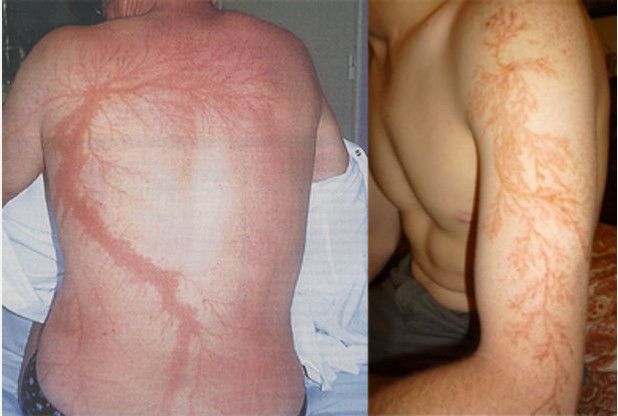 lightning scars on two people